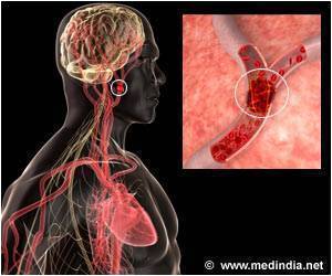 Urinary Tract & Other Infections Increase the Risk of Stroke Urinary Tract & Other Infections Increase the Risk of Stroke