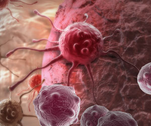 Large Doses of Old Drug found to Stimulate Immune System Attack on Lymphoma Large Doses of Old Drug found to Stimulate Immune System Attack on Lymphoma