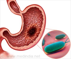 Watch Out: Stomach Cancer No Longer Just a Disease of the Old Watch Out: Stomach Cancer No Longer Just a Disease of the Old