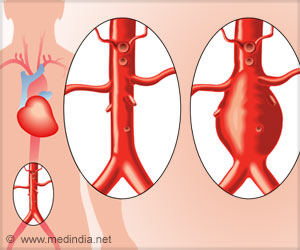 Complex Surgery Gives New Lease of Life to a Man with Hugely-Swollen Artery Complex Surgery Gives New Lease of Life to a Man with Hugely-Swollen Artery