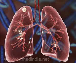 Standard TB Tests may Not Detect Infection in Certain Exposed Individuals, Says Study Standard TB Tests may Not Detect Infection in Certain Exposed Individuals, Says Study