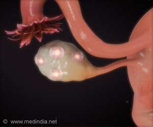 Drug Prolongs Life in resistant Ovarian Cancer Patients Drug Prolongs Life in resistant Ovarian Cancer Patients