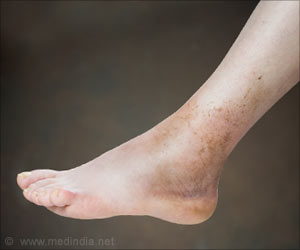 Opioids Prescribed More for a Sprained Ankle: Study Opioids Prescribed More for a Sprained Ankle: Study