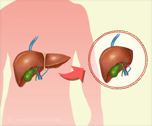 Living Donor Liver Transplants Offer Better Survival Rates and Costs Living Donor Liver Transplants Offer Better Survival Rates and Costs