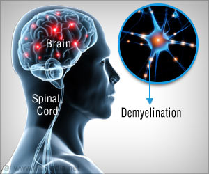 Gadolinium Deposition Identified in Early Multiple Sclerosis Gadolinium Deposition Identified in Early Multiple Sclerosis