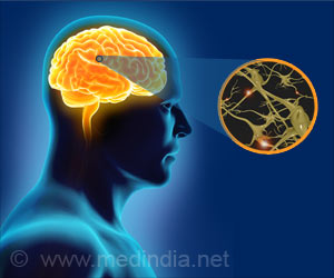 Obesity may Increase the Risk of Pediatric Multiple Sclerosis Obesity may Increase the Risk of Pediatric Multiple Sclerosis