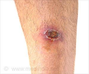 Collagen is Effective in Wound Closure: Study Collagen is Effective in Wound Closure: Study