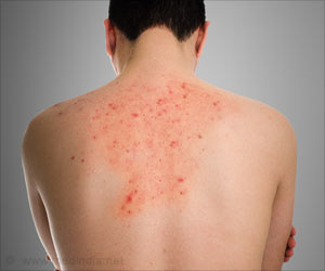 Enzyme Replacement Therapy Launched by Takeda in India Enzyme Replacement Therapy Launched by Takeda in India