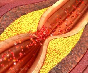 Hot Water Soak Benefits People With Peripheral Artery Disease Hot Water Soak Benefits People With Peripheral Artery Disease