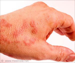 Protecting and Moisturizing the Skin may Help Prevent Allergies in Eczema Patients Protecting and Moisturizing the Skin may Help Prevent Allergies in Eczema Patients