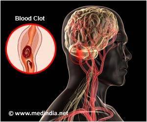 Helicopter Transport for Stroke Patients Reduces Time to Surgery: Study Helicopter Transport for Stroke Patients Reduces Time to Surgery: Study
