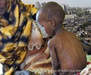 Severely Malnourished Children are Less Exposed to Antimalarial Treatments Severely Malnourished Children are Less Exposed to Antimalarial Treatments