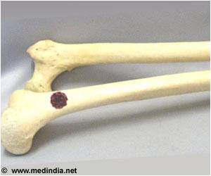 Genetic Similarities of Osteosarcoma Between Dogs and Children Revealed Genetic Similarities of Osteosarcoma Between Dogs and Children Revealed