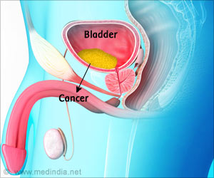 Non-invasive Technique using Urine can Treat Bladder Cancer Effectively Non-invasive Technique using Urine can Treat Bladder Cancer Effectively