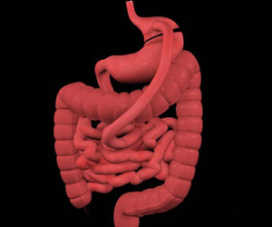 Sleeve Gastrectomy Rates are Rising Among U.S. Patients with Kidney Failure Sleeve Gastrectomy Rates are Rising Among U.S. Patients with Kidney Failure