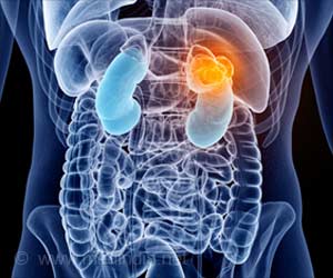 Molecular Traffic Jam may Underlie Rare Kidney Disease Molecular Traffic Jam may Underlie Rare Kidney Disease