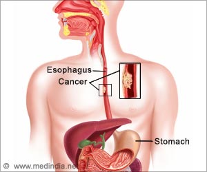 Lymph Nodes Better at Predicting Patient Outcomes in Esophageal Cancer Lymph Nodes Better at Predicting Patient Outcomes in Esophageal Cancer