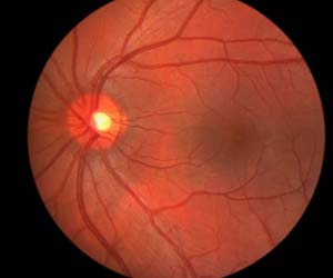 Asthma Drug Slows Down Retinopathy Changes in Type 1 Diabetes Asthma Drug Slows Down Retinopathy Changes in Type 1 Diabetes