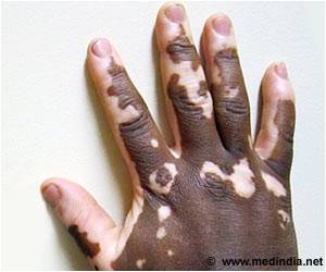 Genetic, Environmental Factors Play a Key Role in the Onset of Vitiligo Genetic, Environmental Factors Play a Key Role in the Onset of Vitiligo