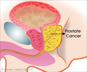 Adjuvant Radiotherapy may Treat Locally Advanced Prostate Cancer Adjuvant Radiotherapy may Treat Locally Advanced Prostate Cancer