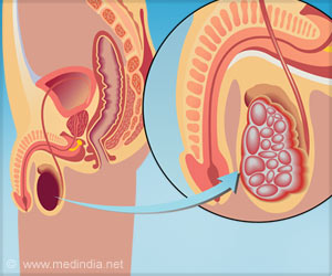 Testicular Cancer Partners With Autoimmune Disease to Cause Maximum Damage Testicular Cancer Partners With Autoimmune Disease to Cause Maximum Damage