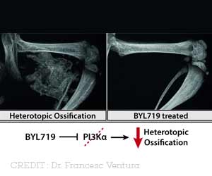 New Treatment to Fight 2 Bone Diseases Discovered New Treatment to Fight 2 Bone Diseases Discovered