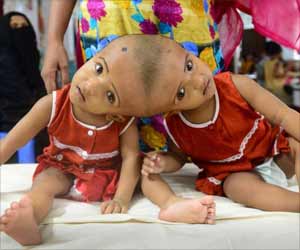 Dhaka Twins Conjoined at Head now Separate and Stable Dhaka Twins Conjoined at Head now Separate and Stable