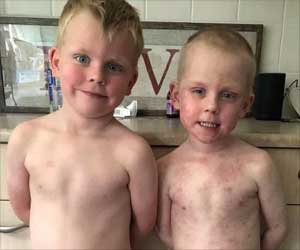 Boy With a Rare Disease That Covered Him in Blisters, and Burns Fights For Life Boy With a Rare Disease That Covered Him in Blisters, and Burns Fights For Life