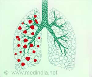 Tuberculosis is Preventable and Curable Tuberculosis is Preventable and Curable
