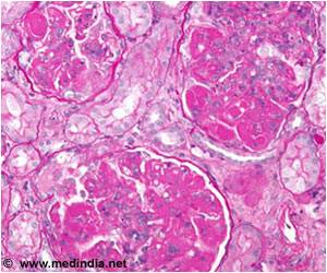 Clotting Proteins in Urine are New Biomarkers for Lupus Nephritis Clotting Proteins in Urine are New Biomarkers for Lupus Nephritis
