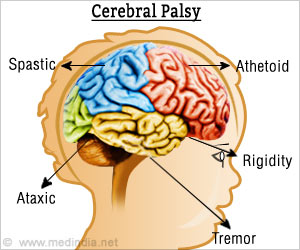 Cerebral Palsy Tied to Raised Risk for Mental Health Disorders Cerebral Palsy Tied to Raised Risk for Mental Health Disorders