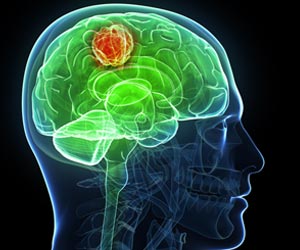 MS Drug Combined with Targeted Cancer Therapy May Improve Glioblastoma Outcomes