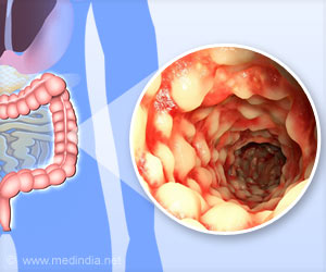 Crohns Disease: Potential, New Target Discovered Crohns Disease: Potential, New Target Discovered