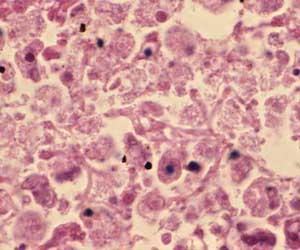 Outbreak of Deadly Legionnaires' Disease at Atlanta Hotel Outbreak of Deadly Legionnaires' Disease at Atlanta Hotel