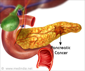 Key to Targeting the Spread of Pancreatic Cancer: Study Key to Targeting the Spread of Pancreatic Cancer: Study