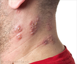 Guidelines for HS Skin Disease Diagnosis Published Guidelines for HS Skin Disease Diagnosis Published