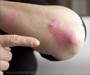 Virtual Patients Help Improve Blue Light Treatment for Psoriasis Virtual Patients Help Improve Blue Light Treatment for Psoriasis