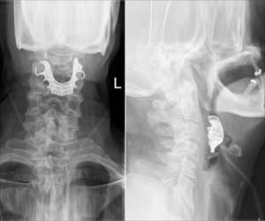 Mans Dentures Got Stuck in Throat Leading to Multiple Surgeries and Hospital Care Mans Dentures Got Stuck in Throat Leading to Multiple Surgeries and Hospital Care