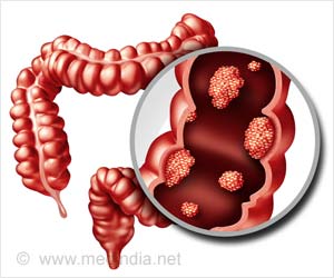 Physical Activity Associated with Progression-free Survival in Colorectal Cancer Physical Activity Associated with Progression-free Survival in Colorectal Cancer