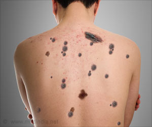 Are Moles Influenced by Genetics? Are Moles Influenced by Genetics?
