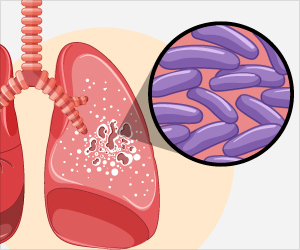 FDA Approves New Pill for Drug-Resistant Tuberculosis