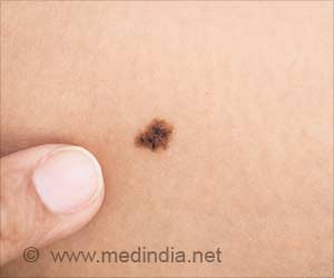 Melanoma Cancers and Moles Have Something in Common Melanoma Cancers and Moles Have Something in Common