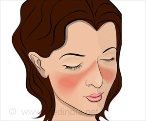 Scientists Identify Lupus Antibody Target Scientists Identify Lupus Antibody Target