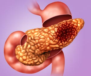 Bacteria on Tumors Influence Survival of Pancreatic Cancer Patients Bacteria on Tumors Influence Survival of Pancreatic Cancer Patients