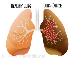 Possible New Treatment Strategy for Lung Cancer Discovered Possible New Treatment Strategy for Lung Cancer Discovered