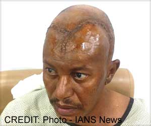 Sudanese Man with Malignant Brain Tumor Treated at Delhi Hospital Sudanese Man with Malignant Brain Tumor Treated at Delhi Hospital