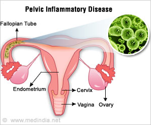 Innovative Care Program Improve Outcomes for Teens, Young Women with Pelvic Inflammatory Disease Innovative Care Program Improve Outcomes for Teens, Young Women with Pelvic Inflammatory Disease
