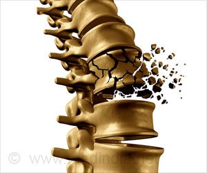 New Drug Target To Reverse Osteoporosis in Mice New Drug Target To Reverse Osteoporosis in Mice