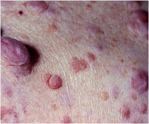 Dermatological Skin Disorder Which Is Itchy, More Prevalent Than Believed Dermatological Skin Disorder Which Is Itchy, More Prevalent Than Believed