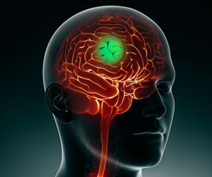 New Drug Target for Glioblastoma Identified New Drug Target for Glioblastoma Identified